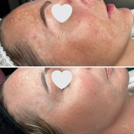 Efekty zabiegów Marsi Beauty przed i po