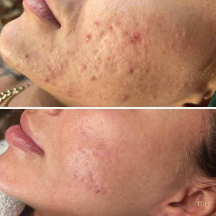 Efekty terapii skóry Marsi Beauty przed i po