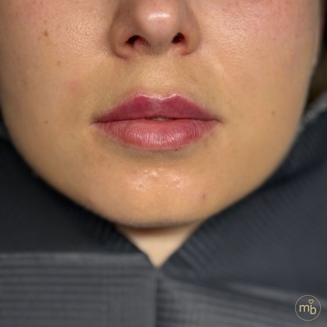 Efekty zabiegów Marsi Beauty przed i po